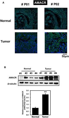 Alpha-Methylacyl-CoA Racemase (AMACR), a Potential New Biomarker for Glioblastoma